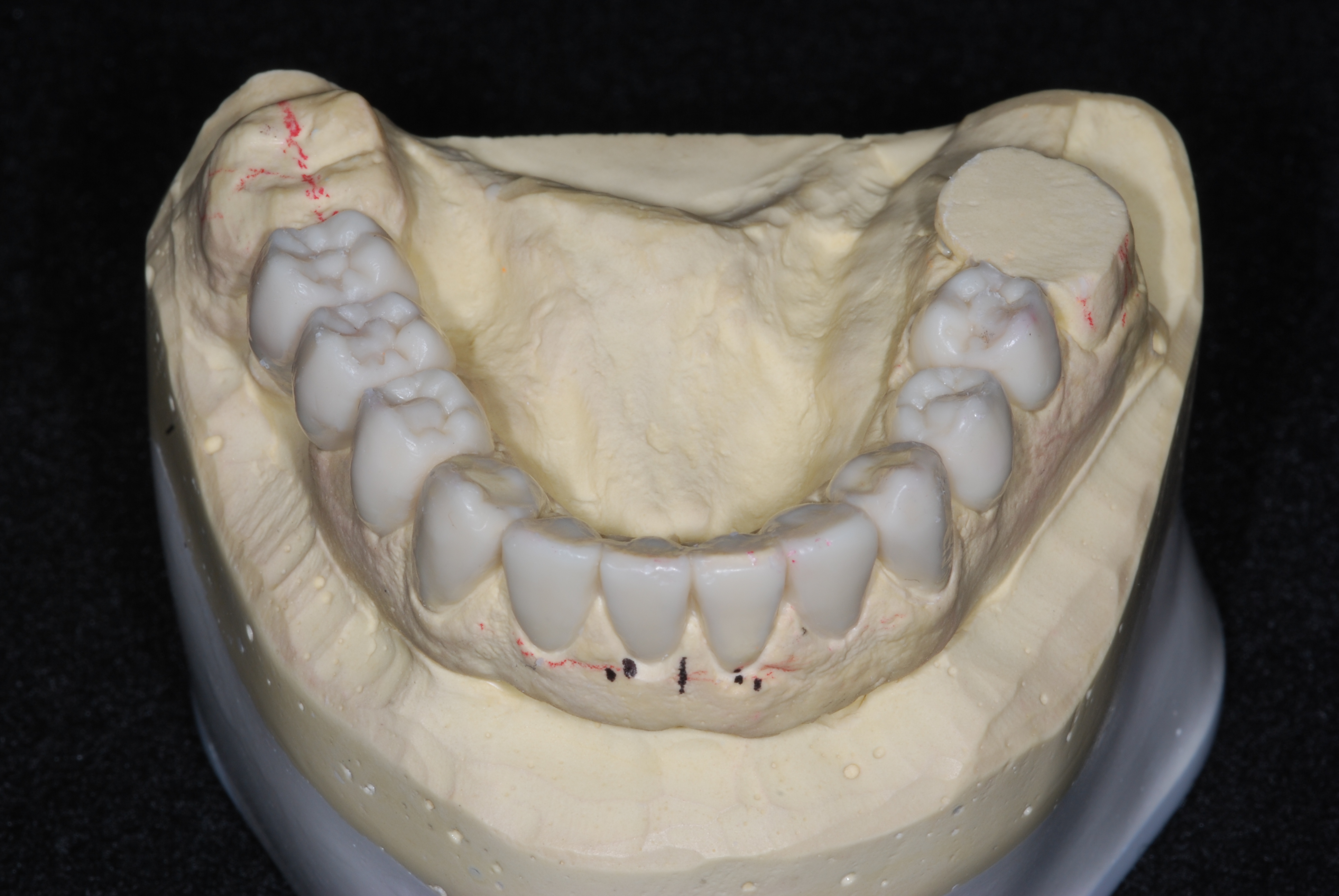 Dental Lab Product Diagnostic Wax Up Local Dental Lab